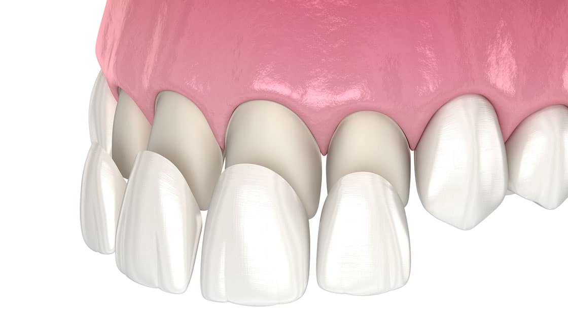 Cosmetic Resin Bonding, Advanced Dentistry